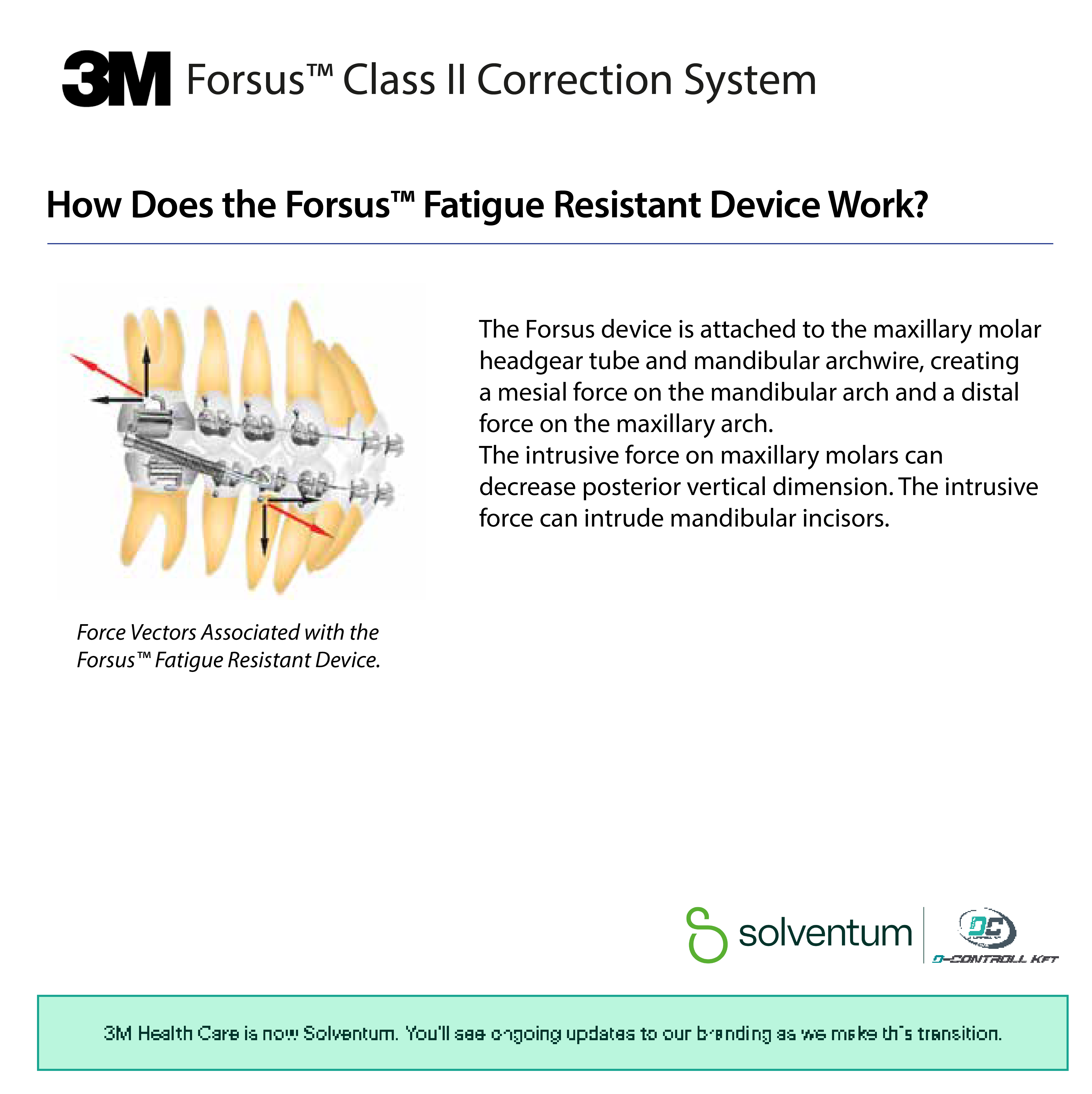 Forsus™ Class II Correction System - 4