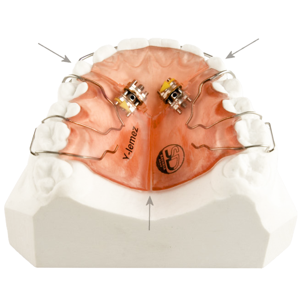 Y Plate orthodontic removable appliance