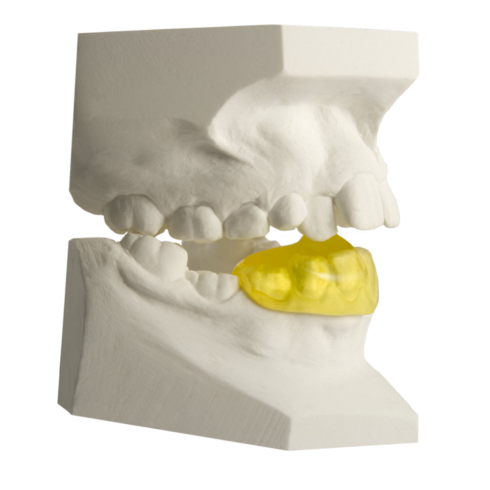 Plan oblique removable orthodontic appliance