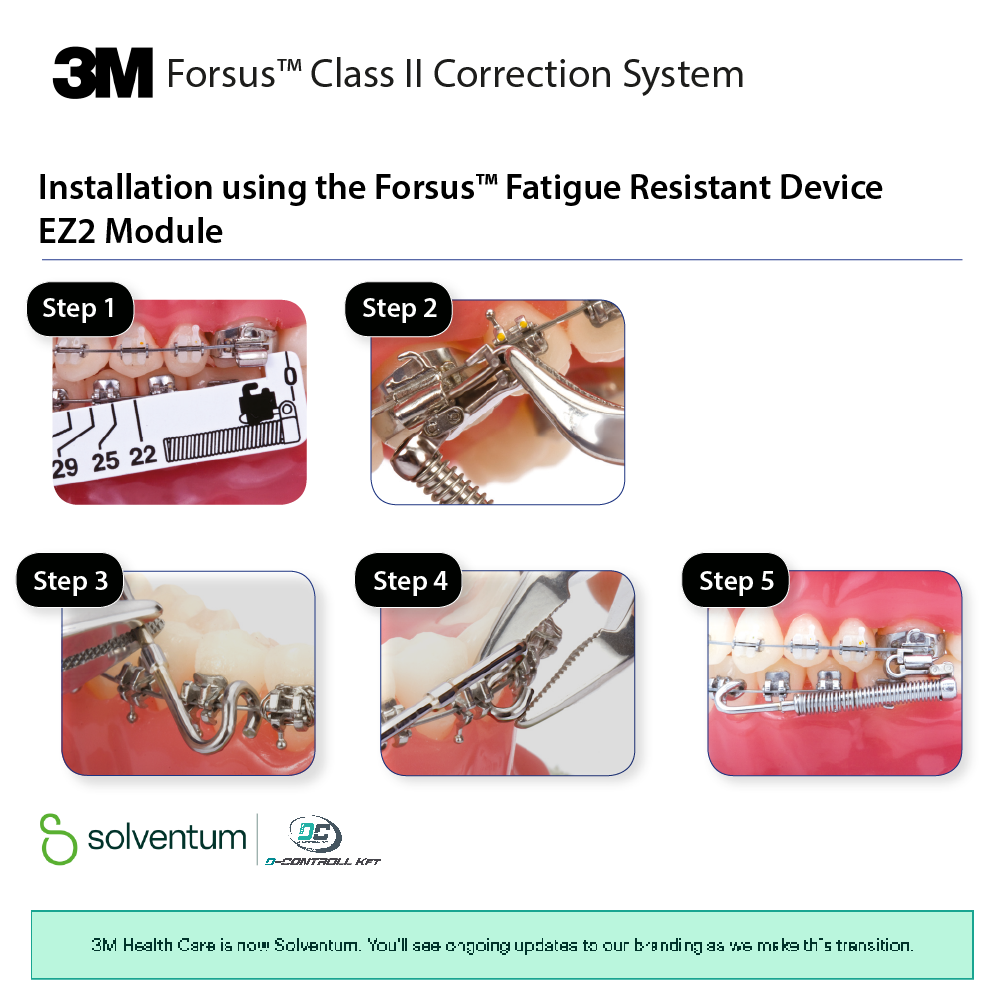 Forsus™ Class II Correction System - 5